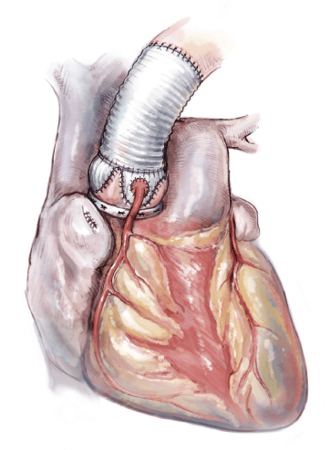 Bicuspid aortic valve