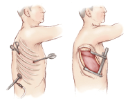 Minimally invasive pulmonary resectxion