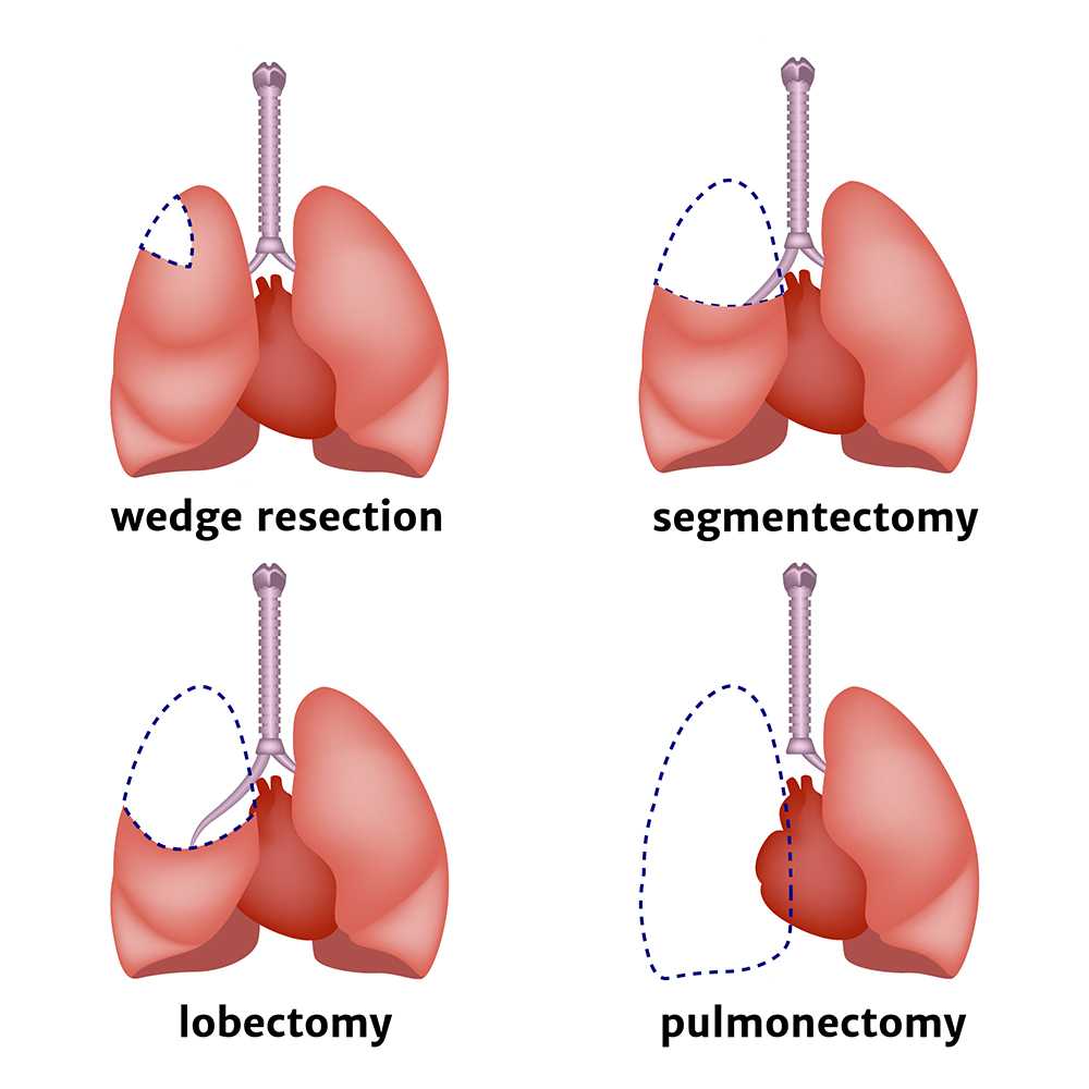 is-the-lump-in-my-throat-cancer-st-vincents-medical-center